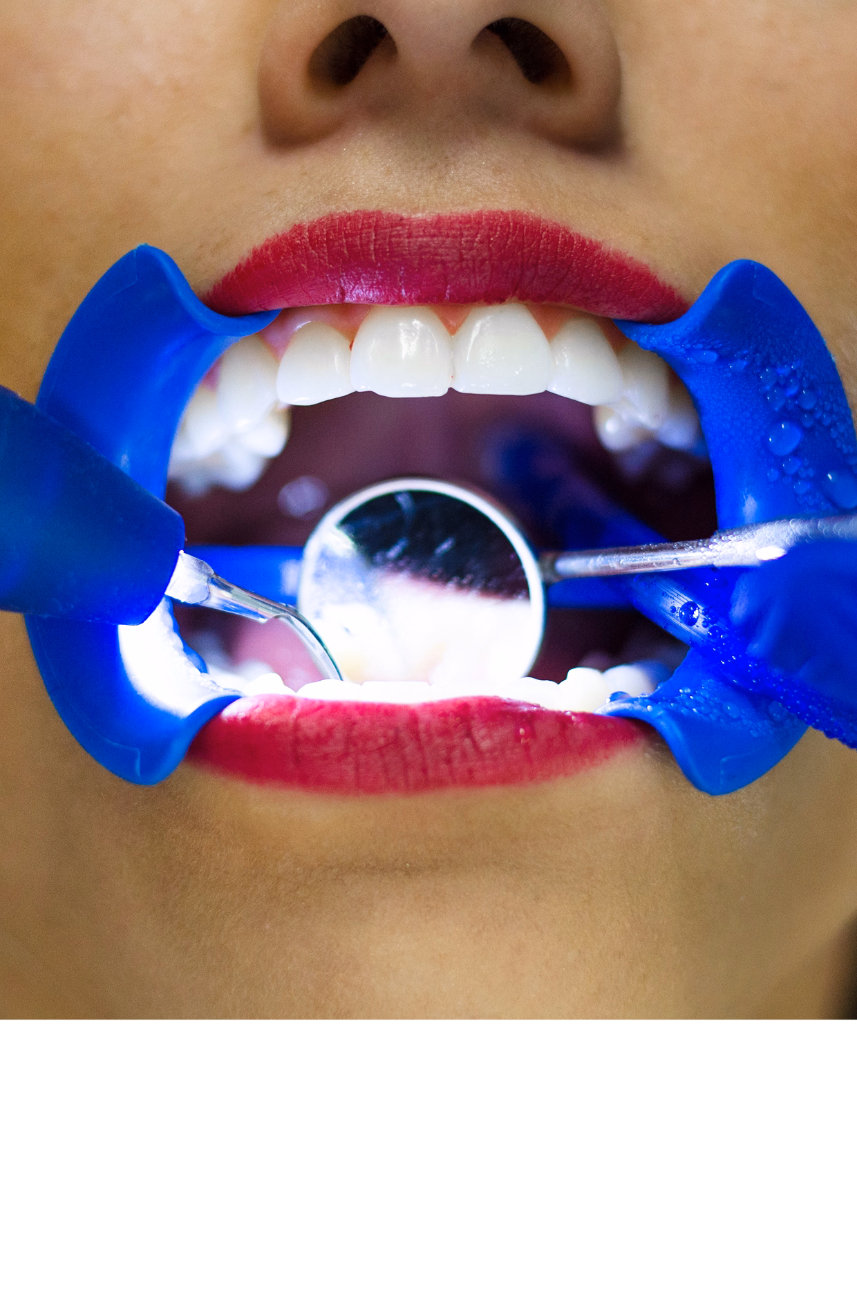 Close-up of a dental examination showing an open mouth with red lipstick, held by a blue retractor. A mirror and dental tools are visible inside.
