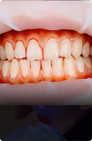 Close-up of a person's open mouth showing upper and lower teeth with slight crowding. The gums appear healthy, and the lighting is clinical.