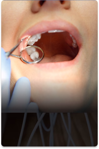 Close-up of an open mouth during a dental check-up, showing a dentist's gloved hand using a mirror to examine teeth. The environment is clinical and focused.