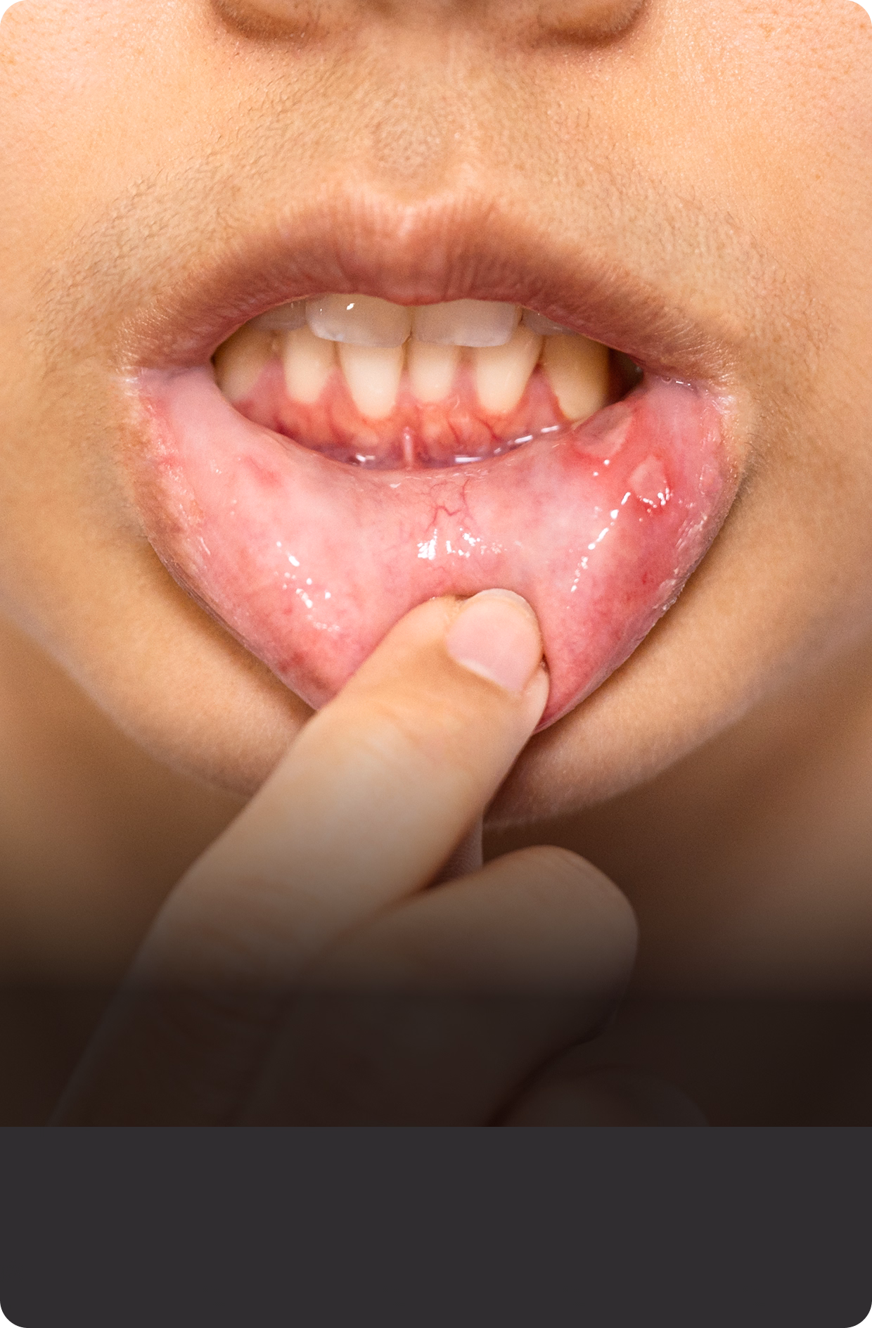 Close-up of a person pulling down their lower lip to reveal swollen gums. The lip and gums appear inflamed and reddish, suggesting possible irritation.